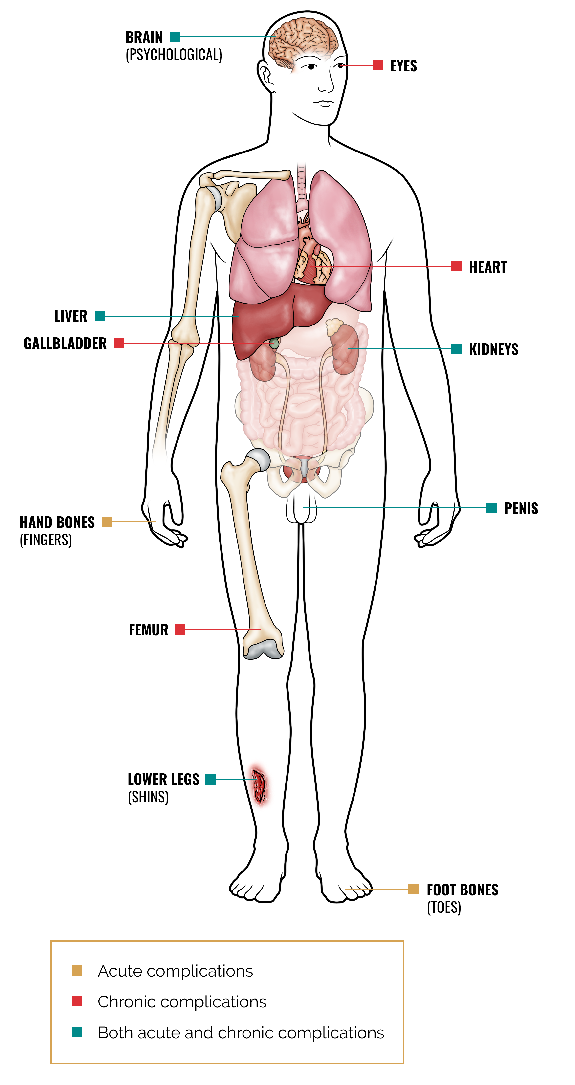 Sickle Cell Symptoms Complications   Acute Chronic Sickle Cell Complications M 